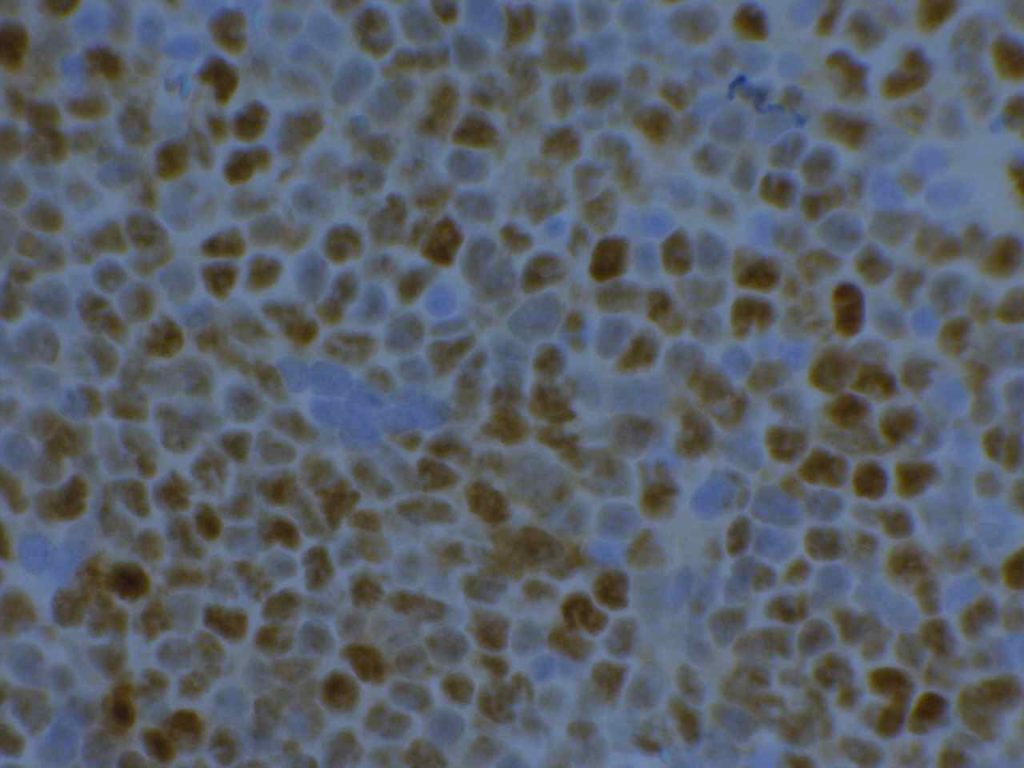 Cyclin D1 (bcl-1) - Mantle Cell Lymphoma