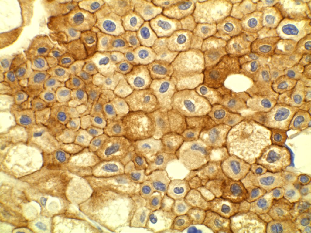 Chromophobe Renal Cell Carcinoma - CD117