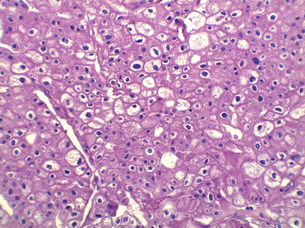 Chomophobe Renal Cell Carcinoma