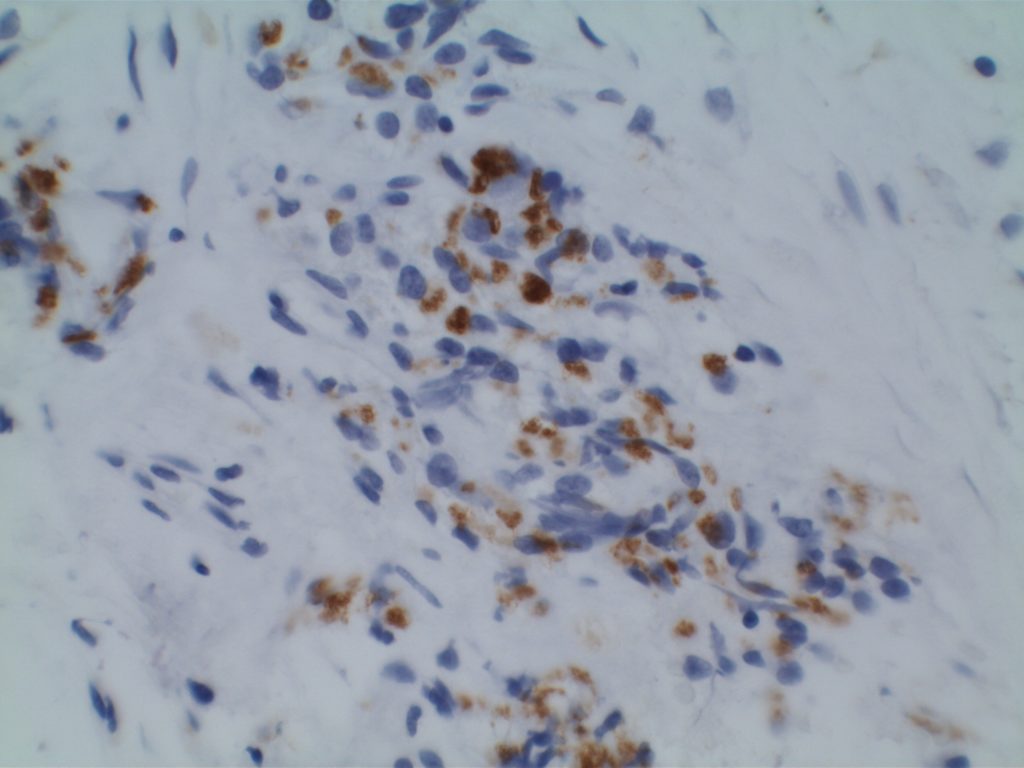 p501s (prostein) - Prostate Adenocarcinoma