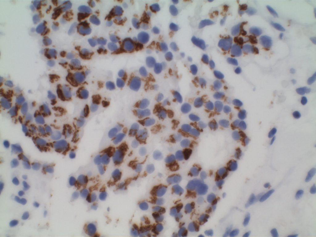 p501s (prostein) - Prostate Adenocarcinoma