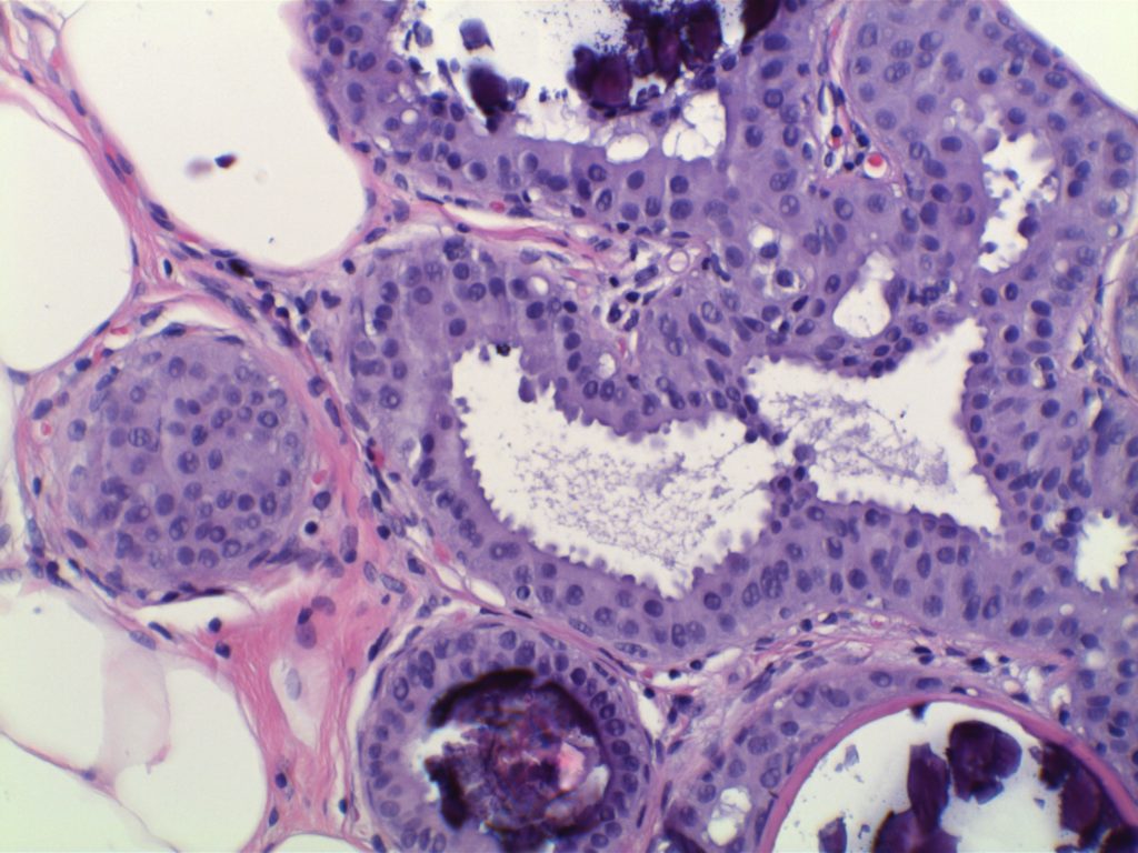 Breast - Flat Epithelial Atypia (FEA)