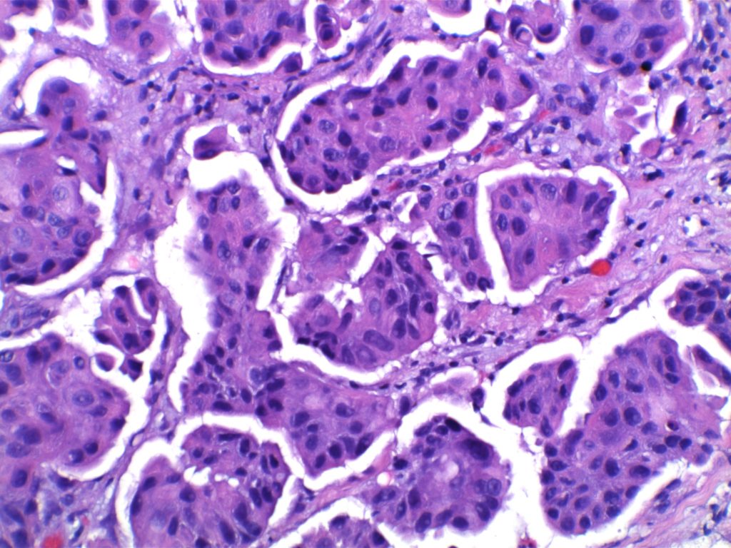 Mircopapillary Breast Carcinoma