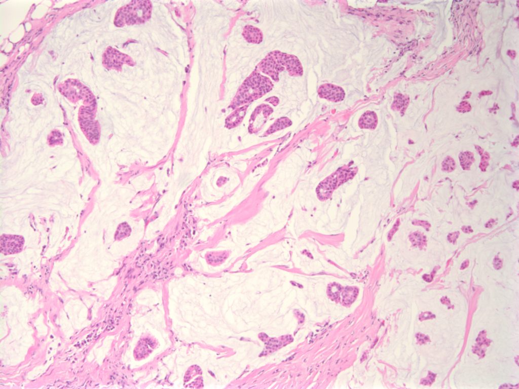 Breast - Mucinous (Colloid) Carcinoma