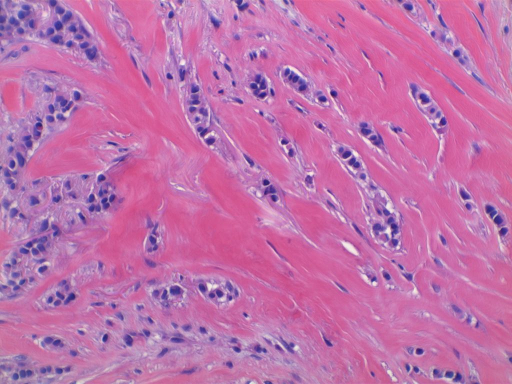 Breast - Invasive Lobular Carcinoma
