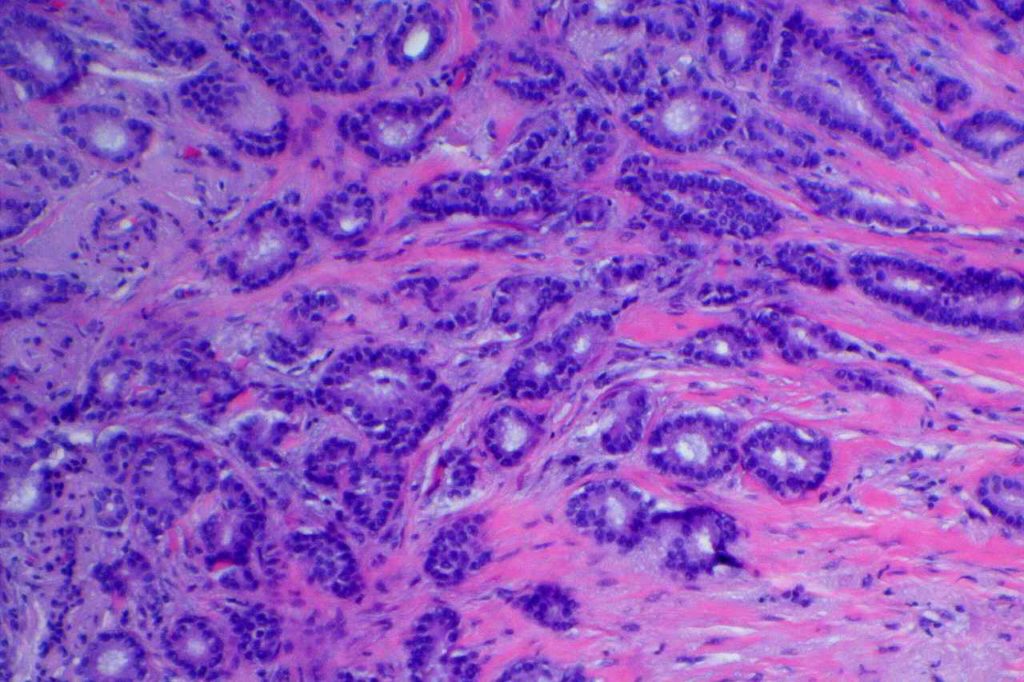 Breast - Tubular Carcinoma