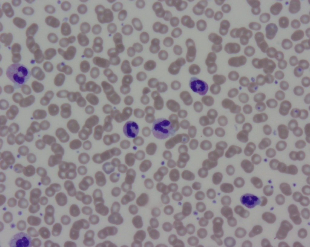 Chronic Neutrophilic Leukemia (CNL) with granulocytic hyperplasia