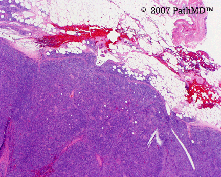 Hematopathology - Part 7, Case #1