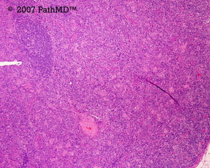 Hematopathology - Part 7, Case #1