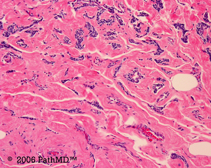 Gynecological Pathology - Part 2, Case #1
