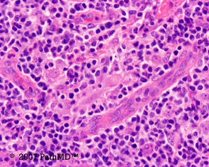 Hematopathology - Part 7, Case #1