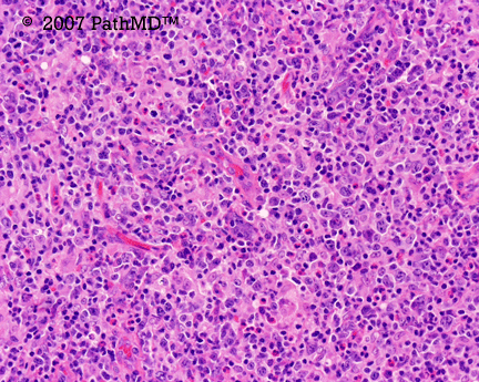 Hematopathology - Part 7, Case #1