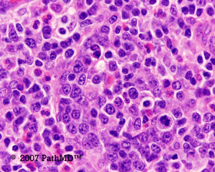 Hematopathology - Part 7, Case #1