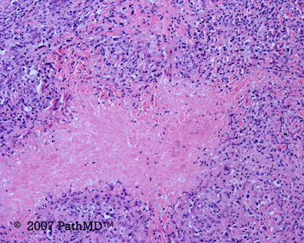 Hematopathology - Part 7, Case #2