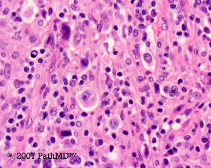 Hematopathology - Part 7, Case #2