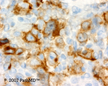 Hematopathology - Part 7, Case #2