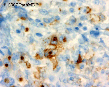 Hematopathology - Part 7, Case #2