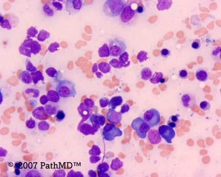 Hematopathology - Part 7, Case #3