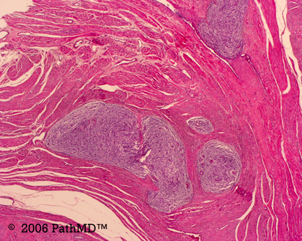 Gynecological Pathology - Part 2, Case #3