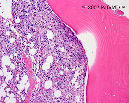 Hematopathology - Part 7, Case #3