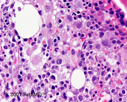 Hematopathology - Part 7, Case #3