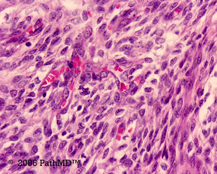 Gynecological Pathology - Part 2, Case #3
