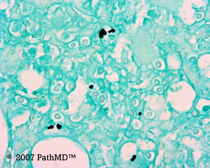 Hematopathology - Part 7, Case #3