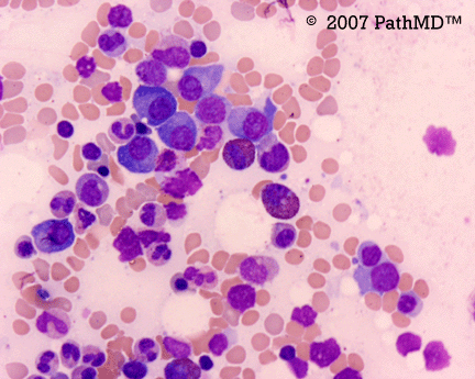 Hematopathology - Part 7, Case #4