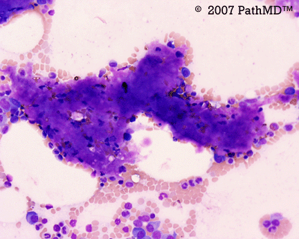 Hematopathology - Part 7, Case #4