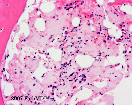 Hematopathology - Part 7, Case #4