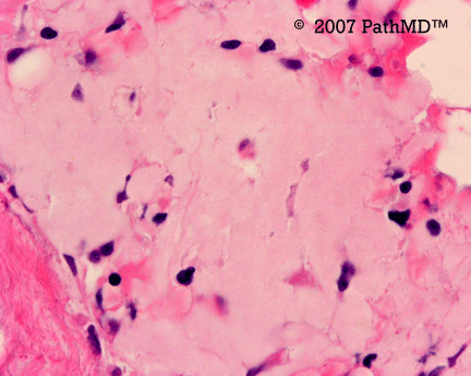 Hematopathology - Part 7, Case #4