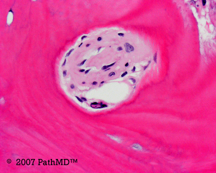 Hematopathology - Part 7, Case #4