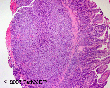 Hematopathology - Part 7, Case #5