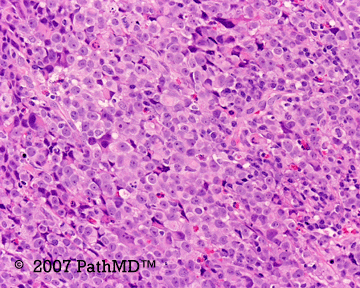 Hematopathology - Part 7, Case #5