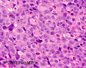 Hematopathology - Part 7, Case #5