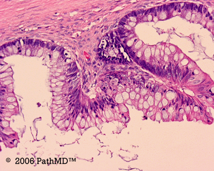 Gynecological Pathology - Part 1, Case #5
