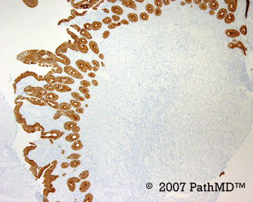 Hematopathology - Part 7, Case #5