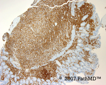 Hematopathology - Part 7, Case #5