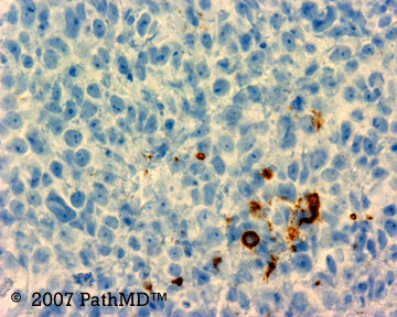 Hematopathology - Part 7, Case #5