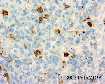 Hematopathology - Part 7, Case #5