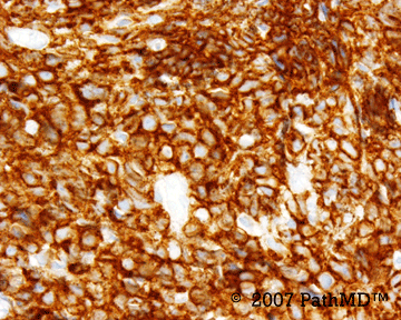 Hematopathology - Part 7, Case #5