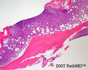 Hematopathology - Part 7, Case #6