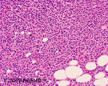 Hematopathology - Part 7, Case #6