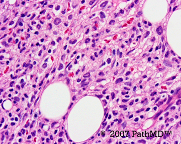 Hematopathology - Part 7, Case #6