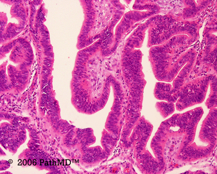 Gynecological Pathology - Part 2, Case #6