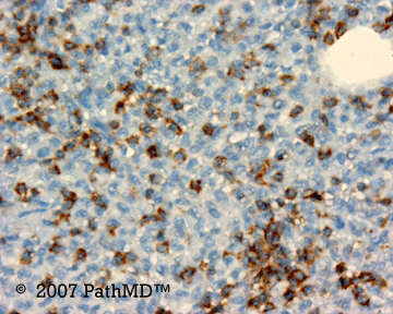 Hematopathology - Part 7, Case #6