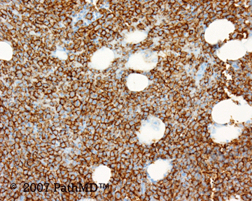 Hematopathology - Part 7, Case #6