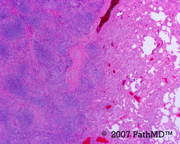 Hematopathology - Part 7, Case #6