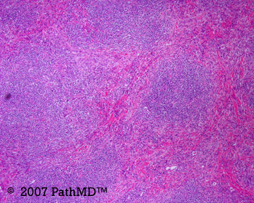 Hematopathology - Part 7, Case #7