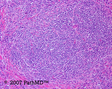 Hematopathology - Part 7, Case #7